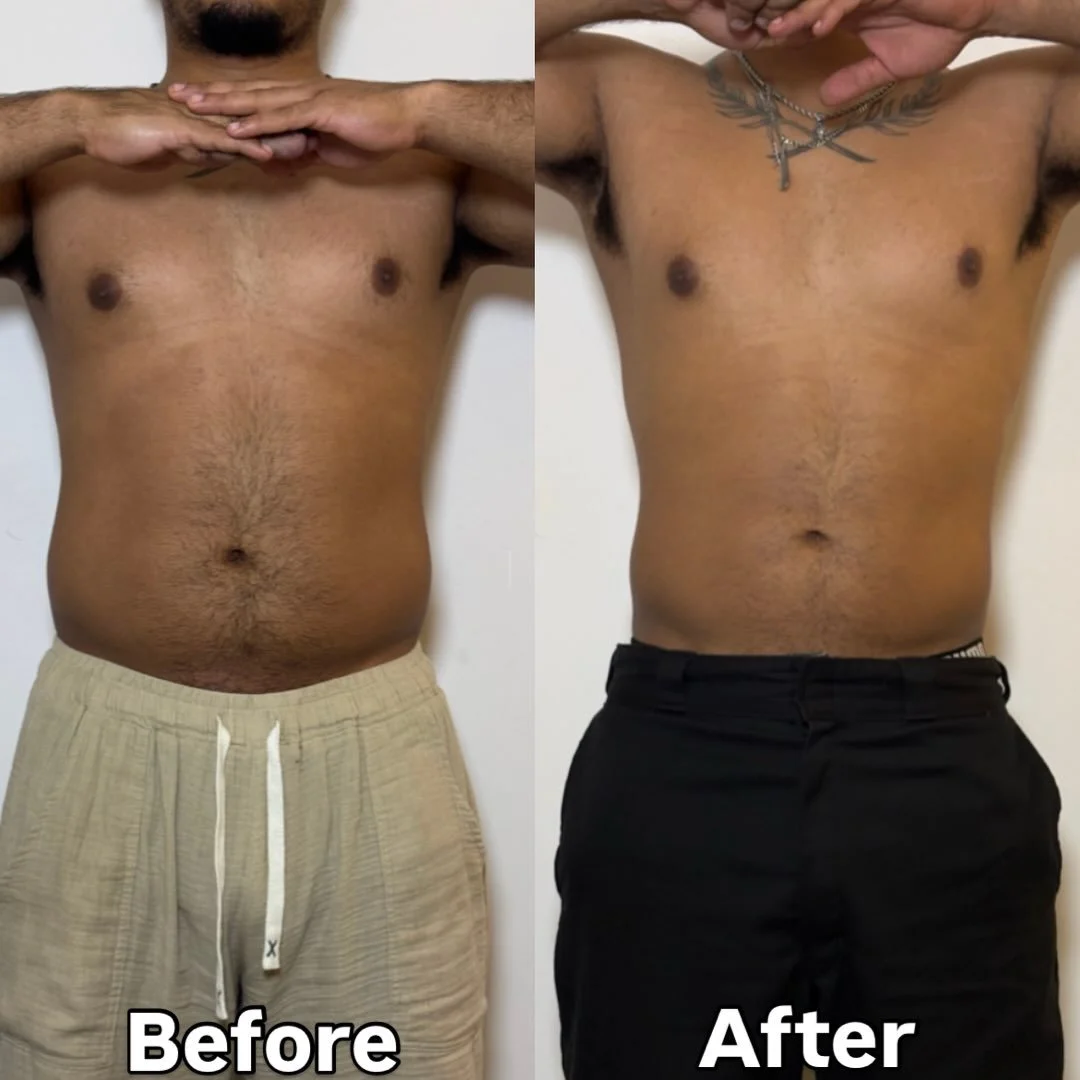 Resultados de uno de nuestros pacientes tras 21 d&iacute;as de protocolo con HCG y plan de alimentaci&oacute;n bajo en calor&iacute;as, supervisado por nuestro equipo m&eacute;dico ✨ Los resultados var&iacute;an seg&uacute;n cada persona. Agenda tu e