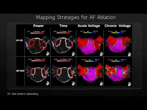 Dr. Elad Anter's Laboratory: A New Ablation Strategy for Atrial Fibrillation published in JACC EP