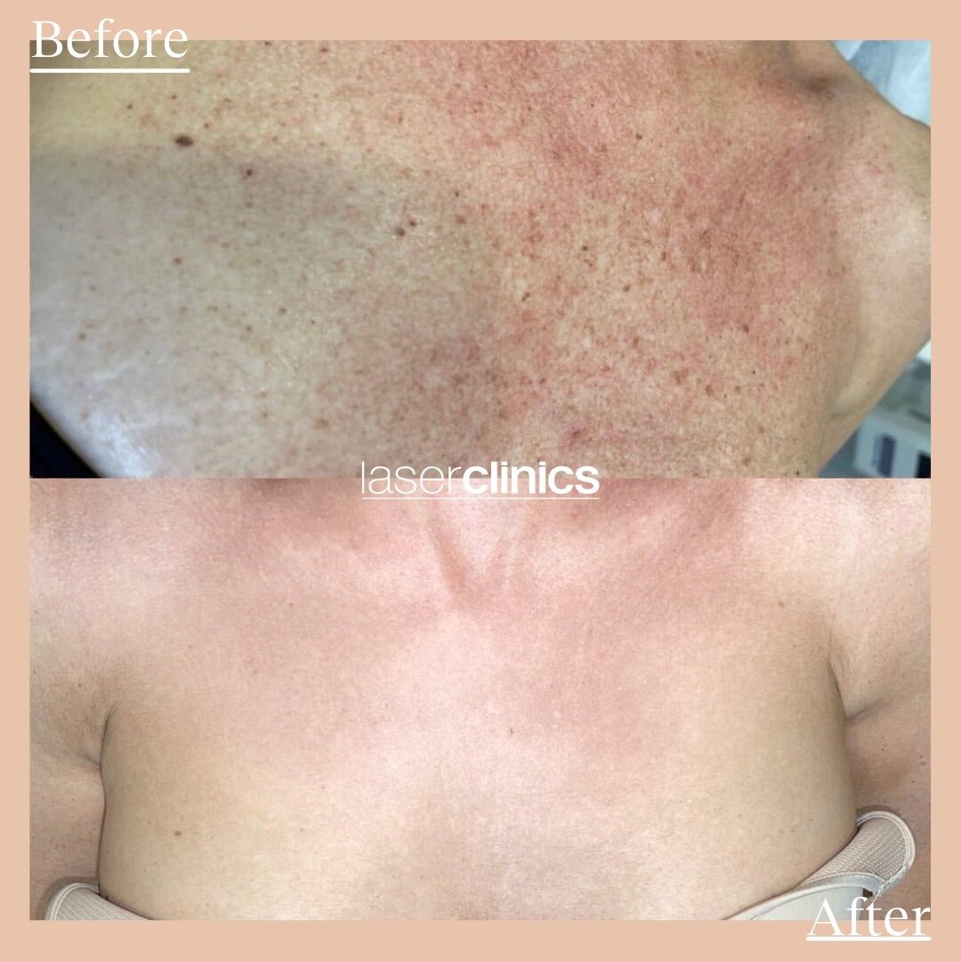 See you later sun damage! ☀️ ⁠
⁠
Can you believe these results from our new Forever Young by BBL Hero treatment? Forever Young by BBL Hero removes sun damage and is clinically proven to treat and delay signs of ageing.⁠ Using pulsed light to regenera