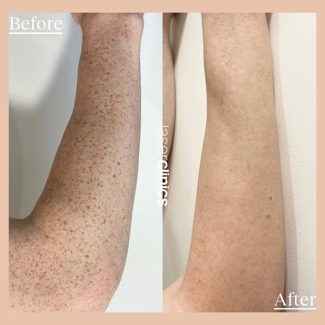 The power of BBL Hero! 🦸⁠
⁠
This clients After image was taken just 4 weeks after 1 Forever Flawless by BBL Hero treatment. BBL Hero offers 4 different treatment types to address a variety of skin concerns associated with ageing, sun, acne and envir