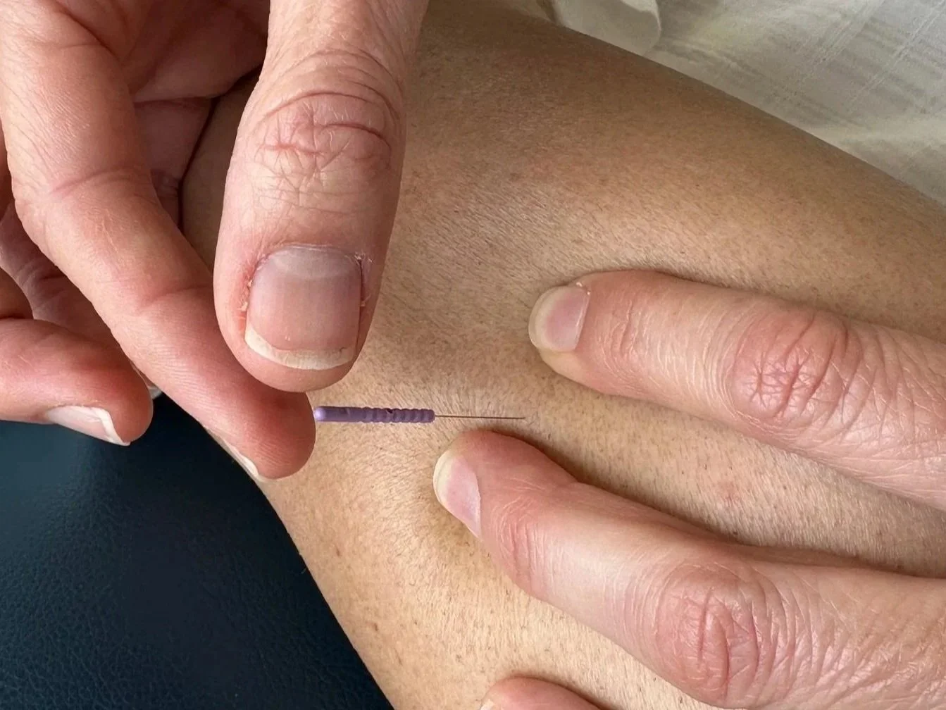 Got a Stubborn Muscle Knot That Won't Budge? Here's What Dry Needling Actually Does