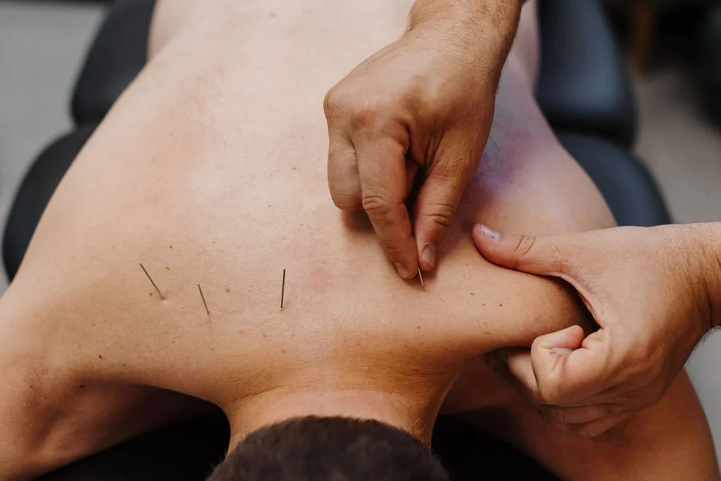 Dry Needling