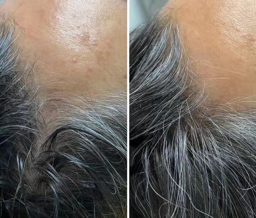 Would you believe his own body helped him get here? 🤯 

PRP for hair restoration has been studied to be an impactful therapy for male and female pattern hair loss. It entails the process of drawing one's own blood, spinning it down, and retrieving t
