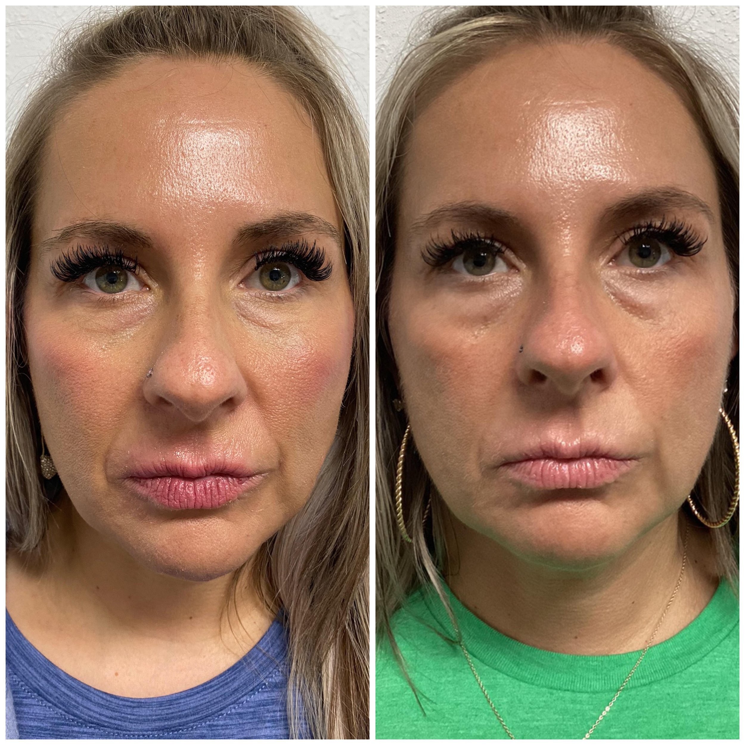 Midface filler is the name of the game 💉 😍

This gorgeous client of ours received 3 syringes to achieve these results, placed in the midface/cheeks and undereye hollows. 

Reminder that was are running a special right now for buy 2 syringes get one