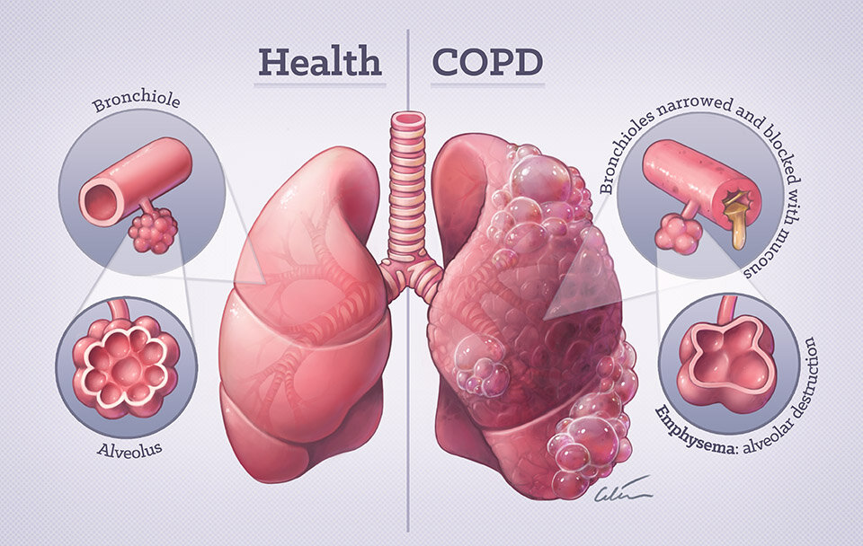Was ist COPD und wie können Pulsoximeter dabei helfen? – Wellue