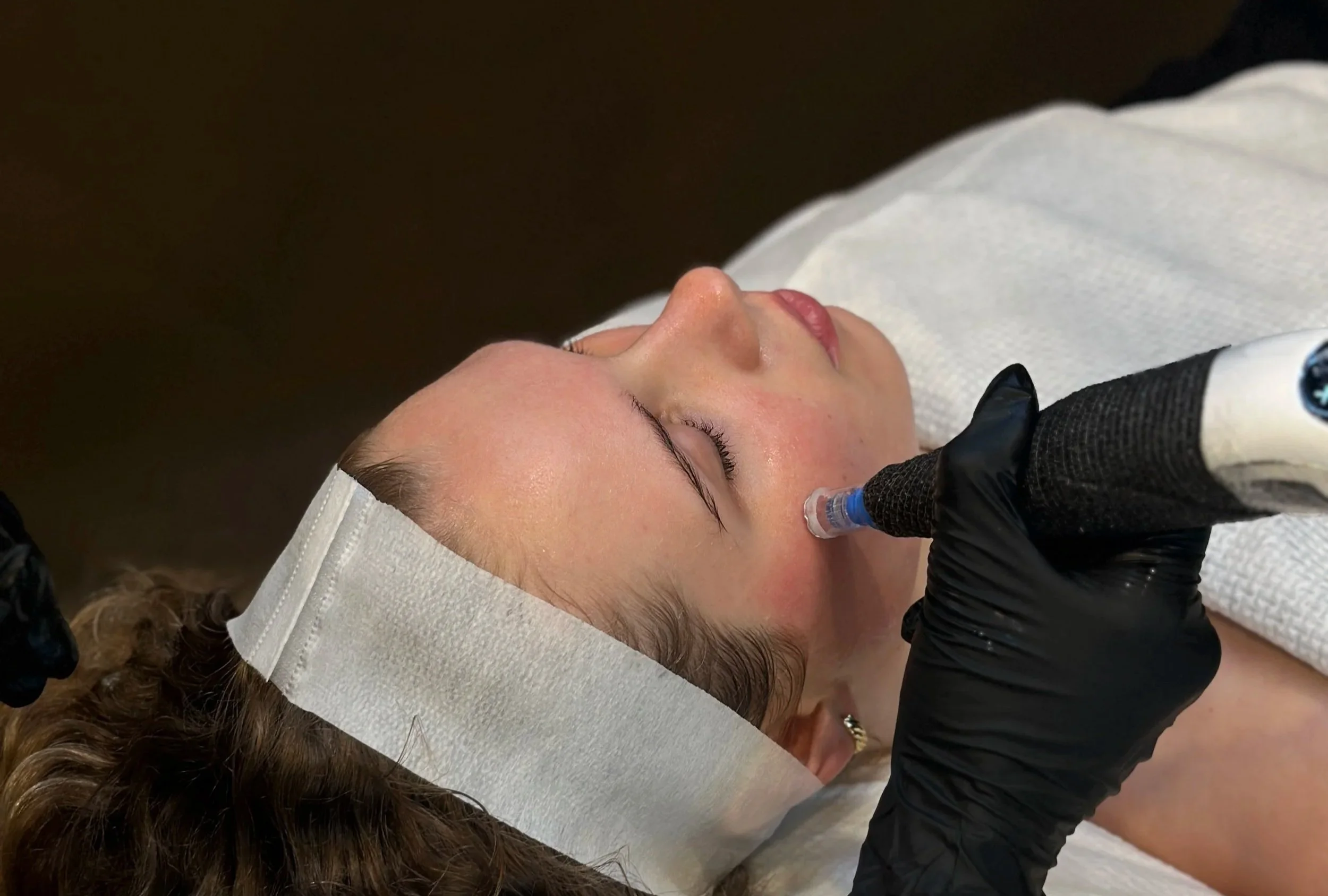 Professional skin needling treatment being performed at Mediluxe