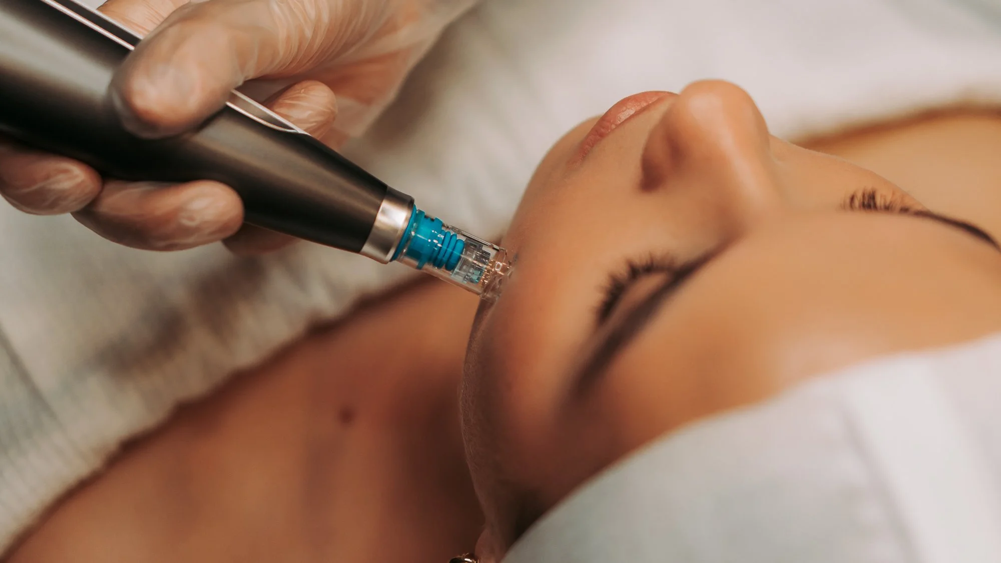 Skin needling at Mediluxe