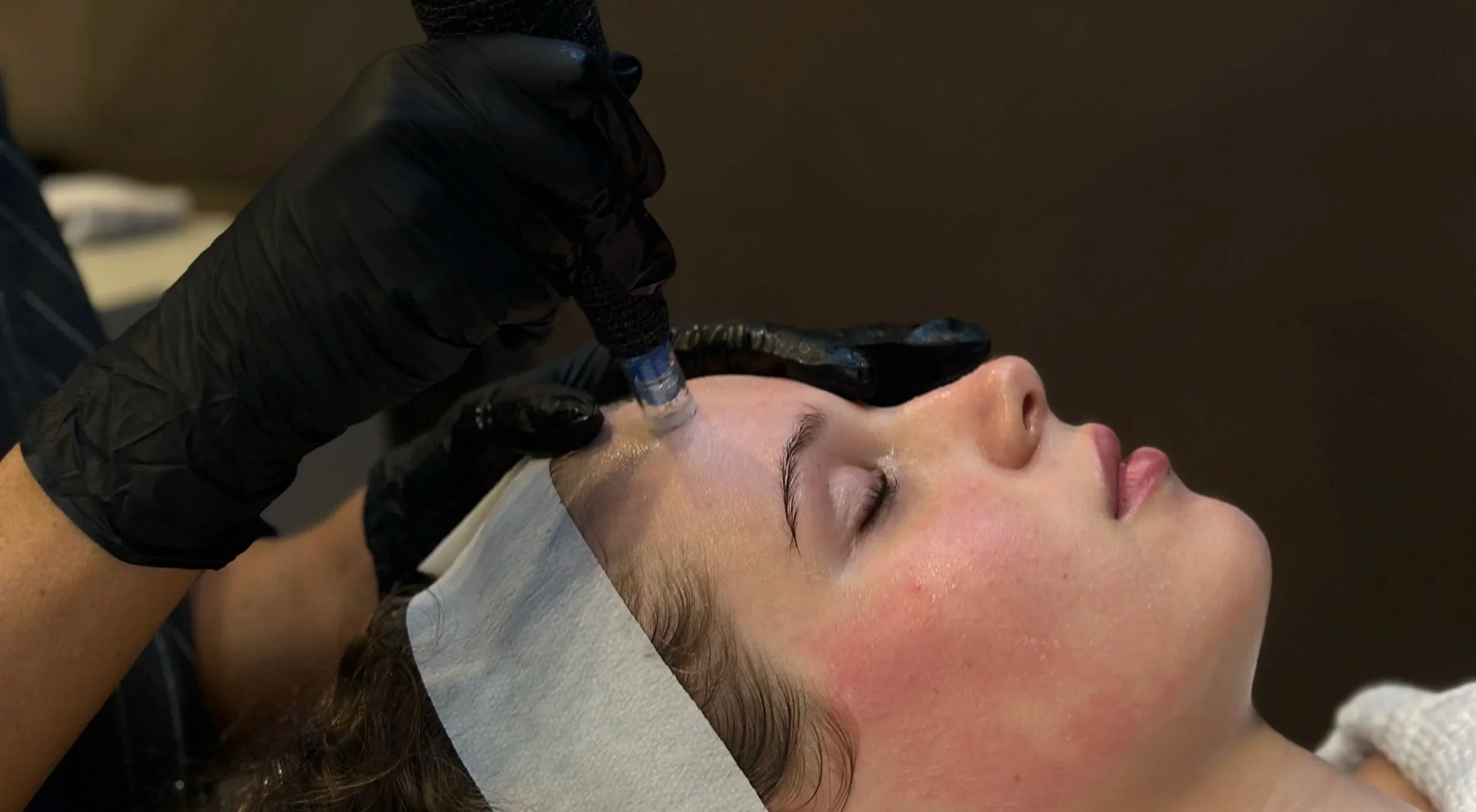 Professional skin needling treatment being performed at Mediluxe