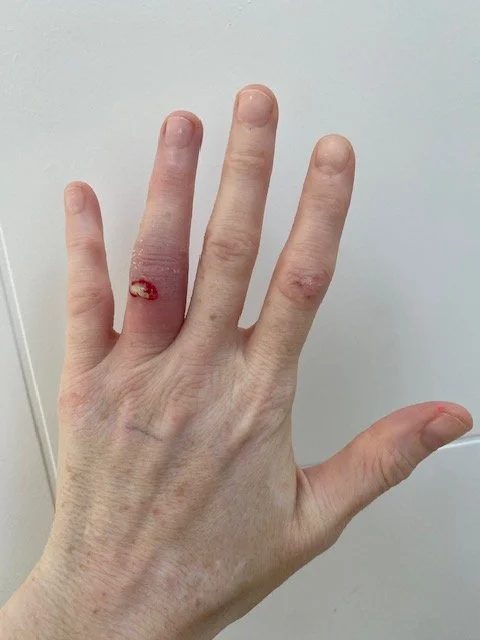 Sarah's left hand with a swollen finger expressing pus and blood