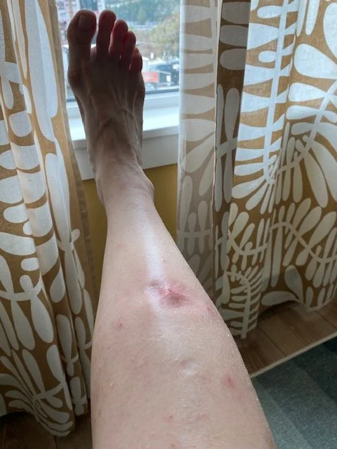 Sarah's right leg with a large indent around a red wound