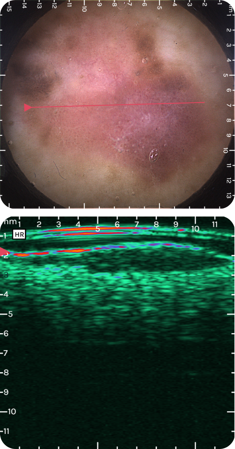 a_melanoma.png