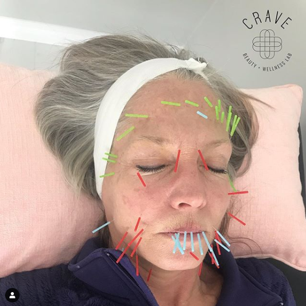 Discover what acupuncture facial can do CRAVE BEAUTY LAB