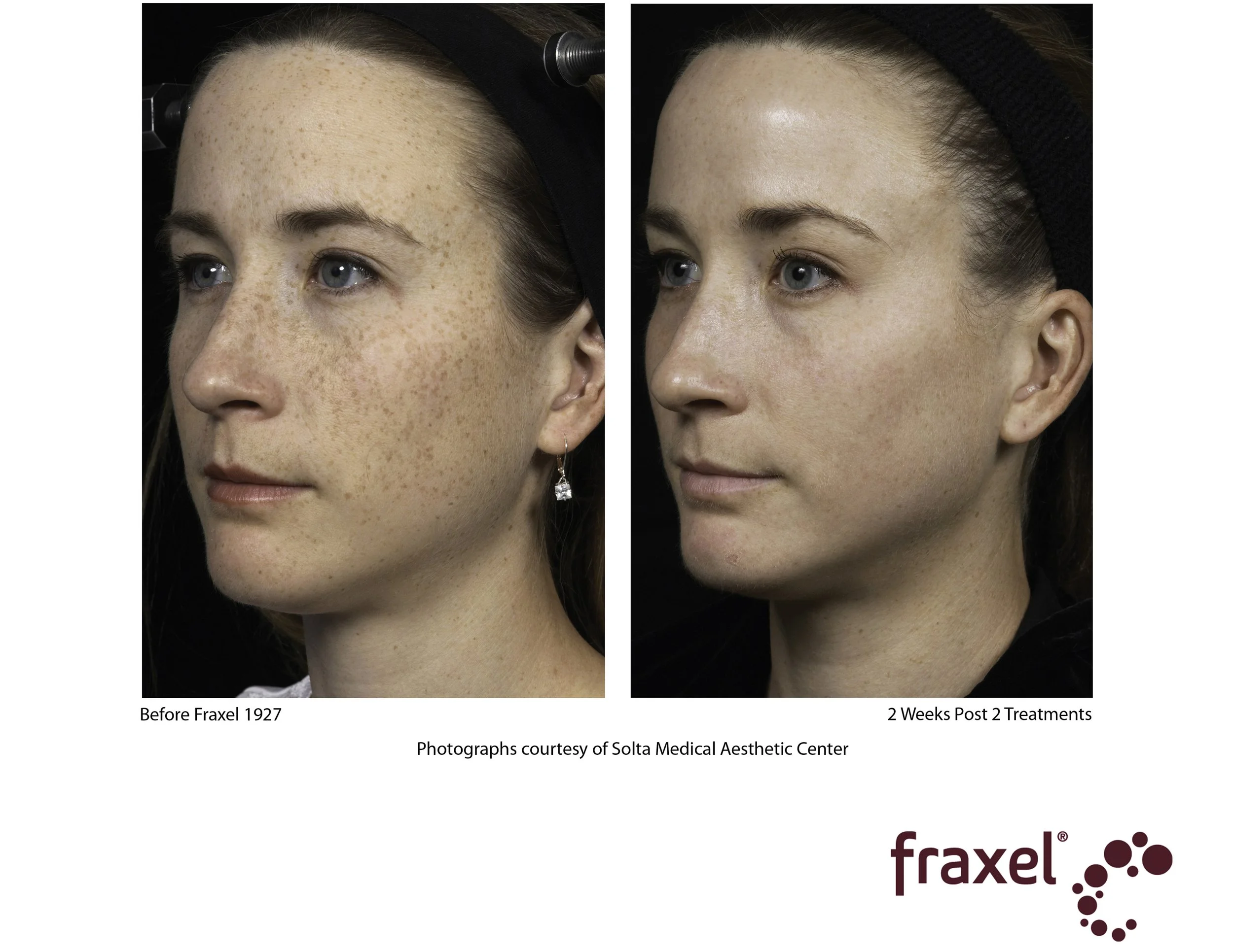 0139-Fraxel_1927_HiRes.jpg