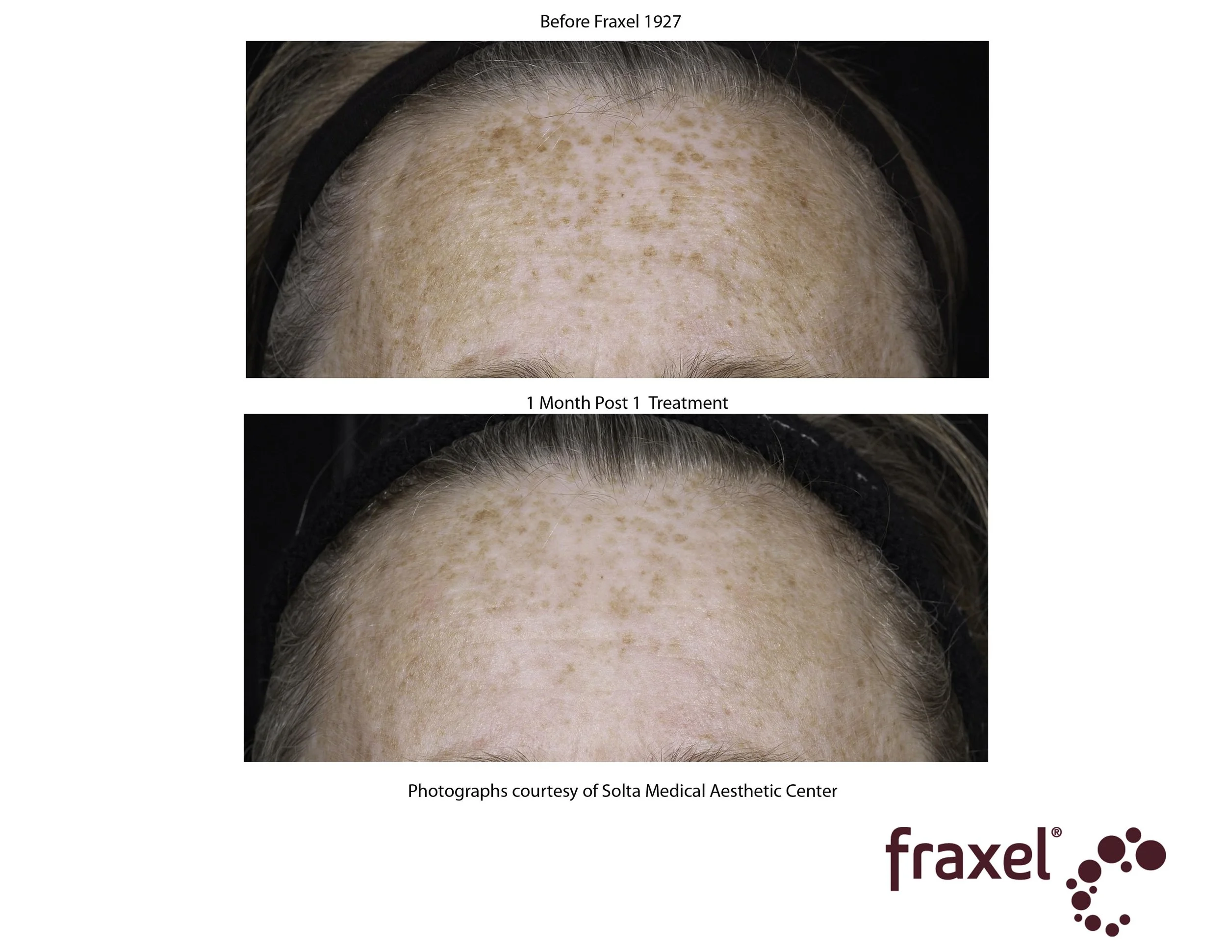 Copy of 0766-Fraxel1927_LoRes.jpg