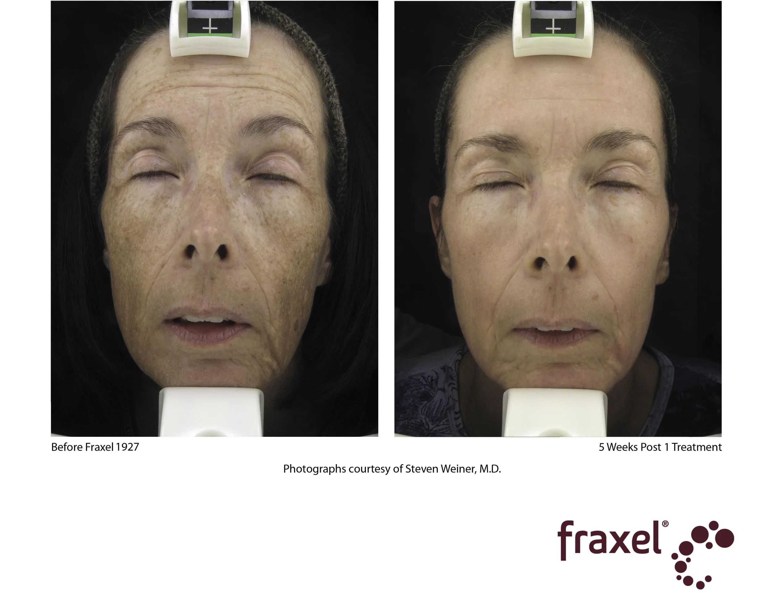 Copy of E016-Fraxel_3_1927_LoRes.jpg