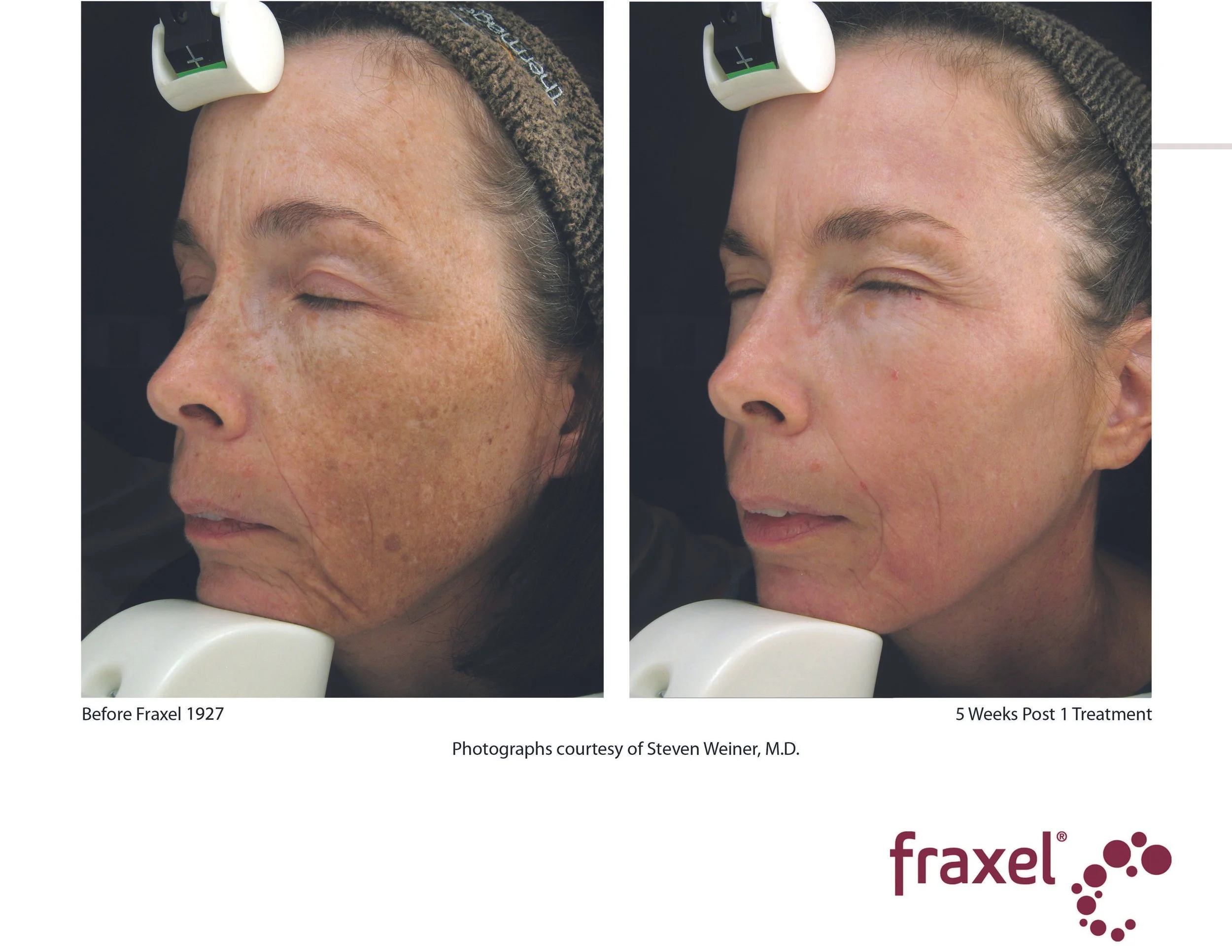 Copy of E016-Fraxel_2_1927_LoRes.jpg