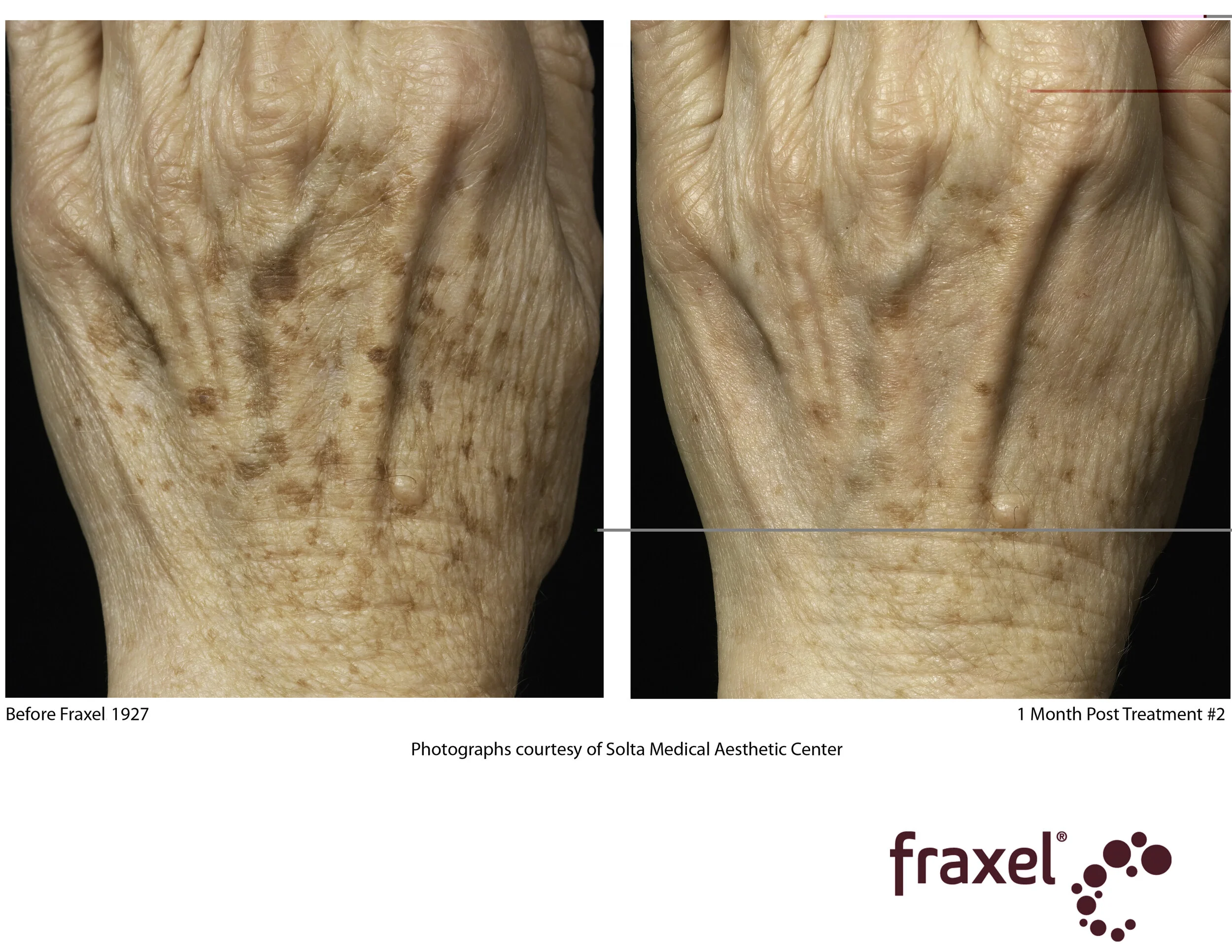 Copy of 0318-Fraxel_1927_HiRes.jpg