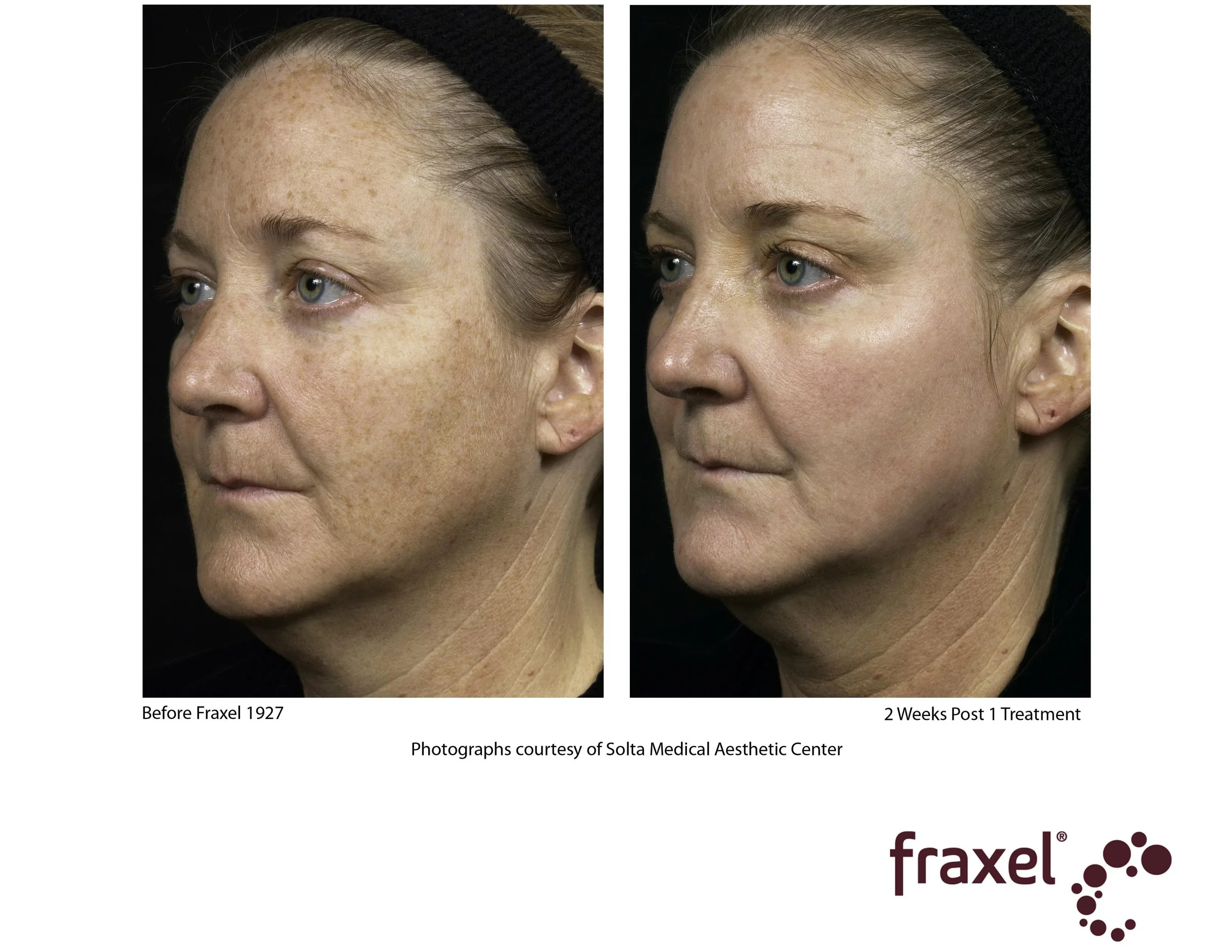 0280-Fraxel_1927_2_LoRes.jpg