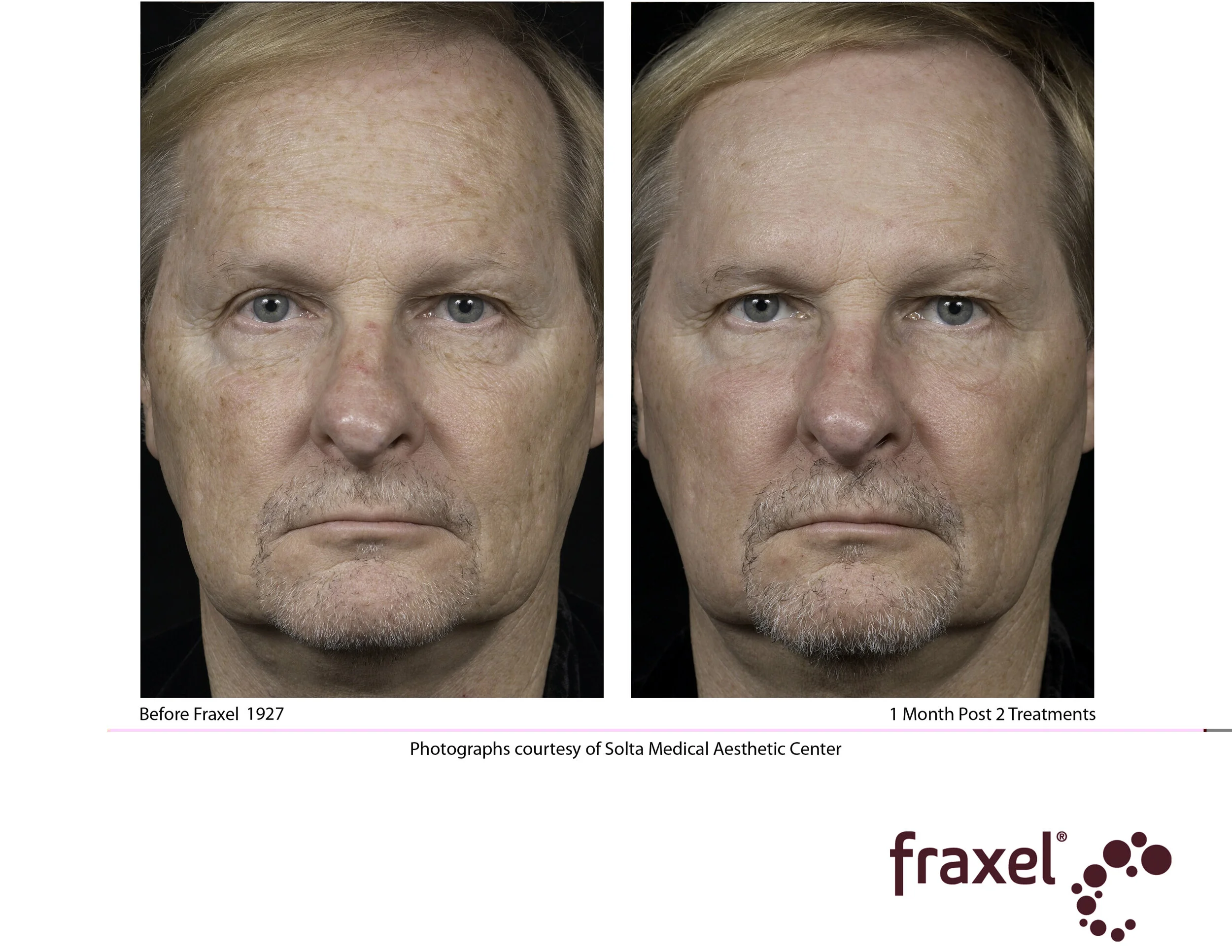 Copy of 0565-Fraxel_1927_HiRes.jpg