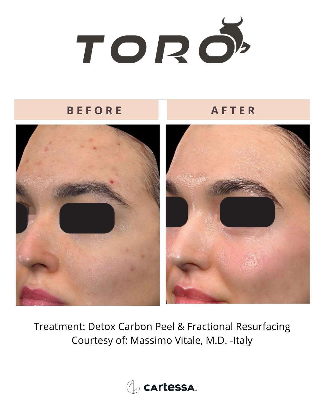 Copy of ToroBA3175017268031.png