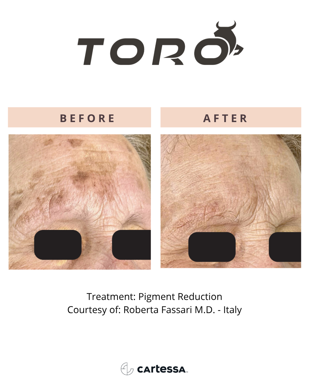 Copy of ToroBA5175017268260.png