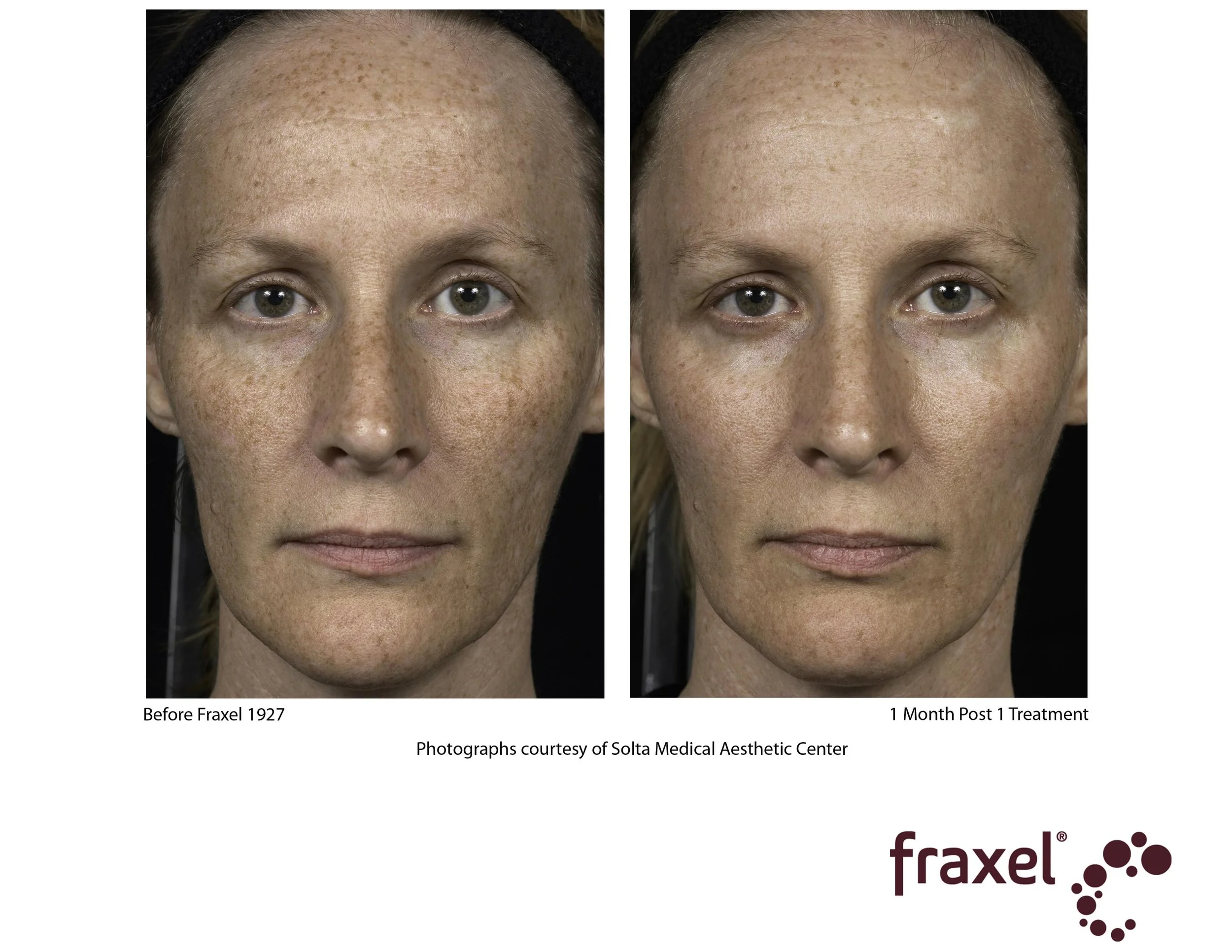 Copy of 0279-Fraxel_1927_2_LoRes.jpg