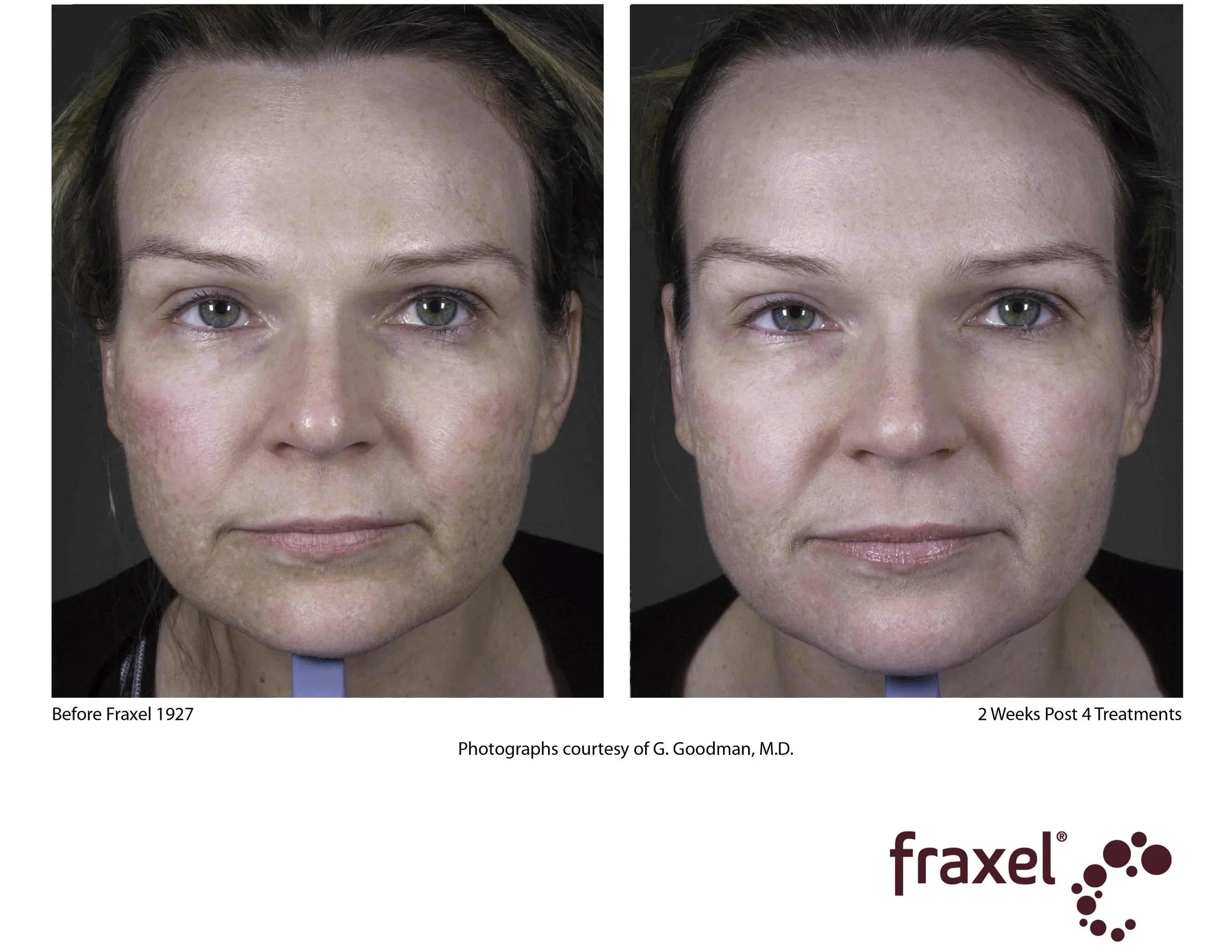Copy of E196-Fraxel-1927_LoRes.jpg