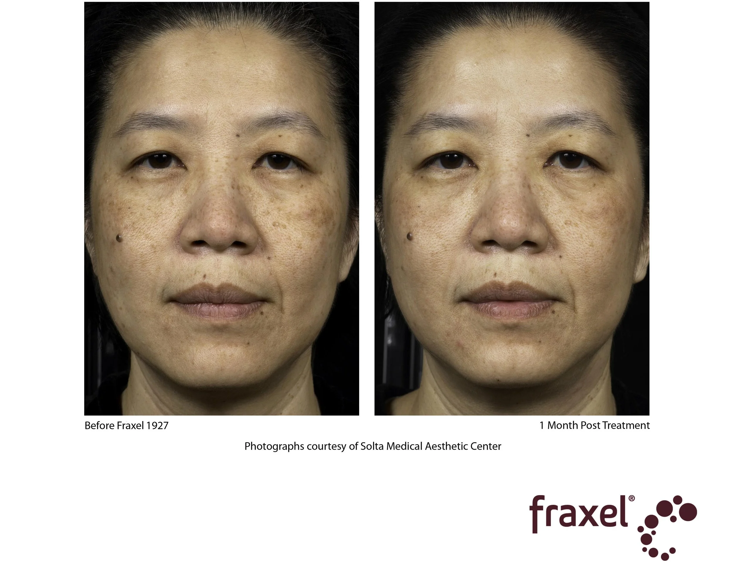 0357-Fraxel_1927_1_LoRes.jpg