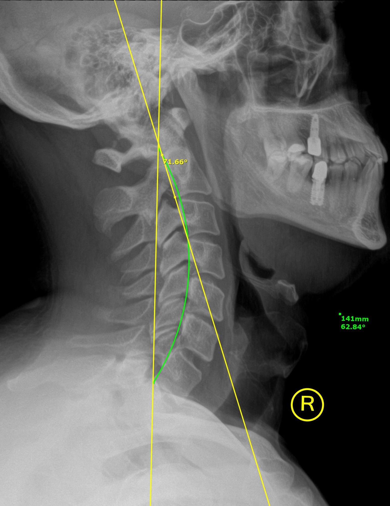 Why Use X-Ray Technology for Chiropractic Care