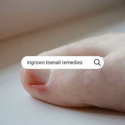 Amazon.com : Nail Fungus Laser Treatment for Toenails, FSA or HSA eligible  Highly Effective Blue Light Laser Therapy to Treat Onychomycosis,  Revolutionary Nail Fungus Treatment, Easy to Use at Home, Elderly :