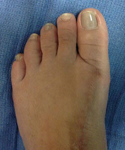 bunions-after1.jpg