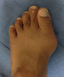 bunions-before2.jpg