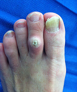 hammertoe-before1.jpg