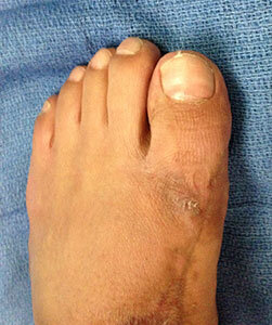 bunions-after2.jpg