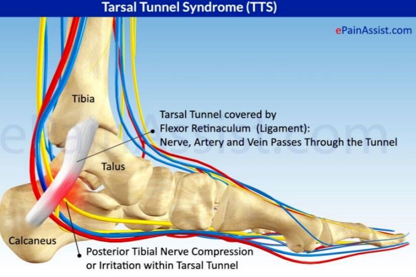Tarsal Tunnel Syndrome Podiatrist In Torrance Los Angeles And San