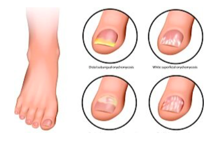 Top Tips for Preventing Toenail Problems — Precision Foot and Ankle Centers