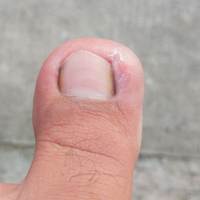 Why Does This Ingrown Toenail Keep Coming Back? — Precision Foot