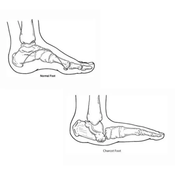 Have Diabetes? Watch Out for Charcot Foot — Precision Foot and Ankle