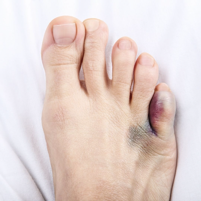 Hammer Toe Treatment - Looking Glass Foot & Ankle Center