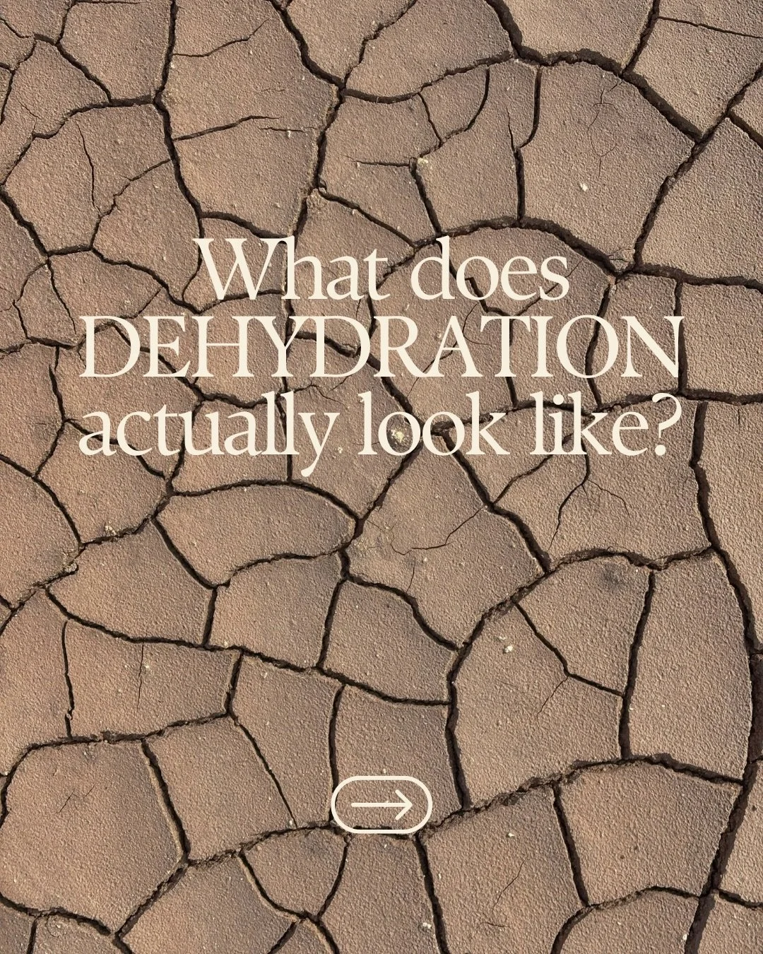 Dehydration isn&rsquo;t just &ldquo;being thirsty.&rdquo;
It can look like fatigue, brain fog, headaches, dry skin, and slow recovery.
IV therapy delivers fluids + nutrients directly into your bloodstream, helping your body rehydrate faster and more 