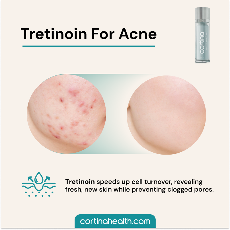 Tret For Acne.png