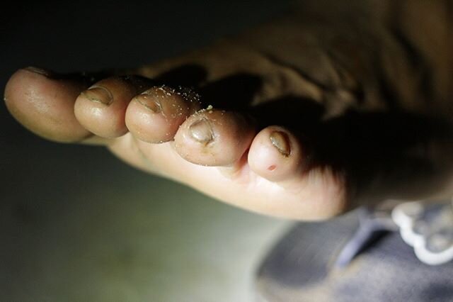 🧛&zwj;♂️ Drinking blood in nature. WARNING: this is a photo of an actual vampire bat bite on a human toe. Lovely...🦇
.
Vampire bats release an anticoagulant, like mosquitos, to prevent blood clotting when they bite an organism to drink their blood.