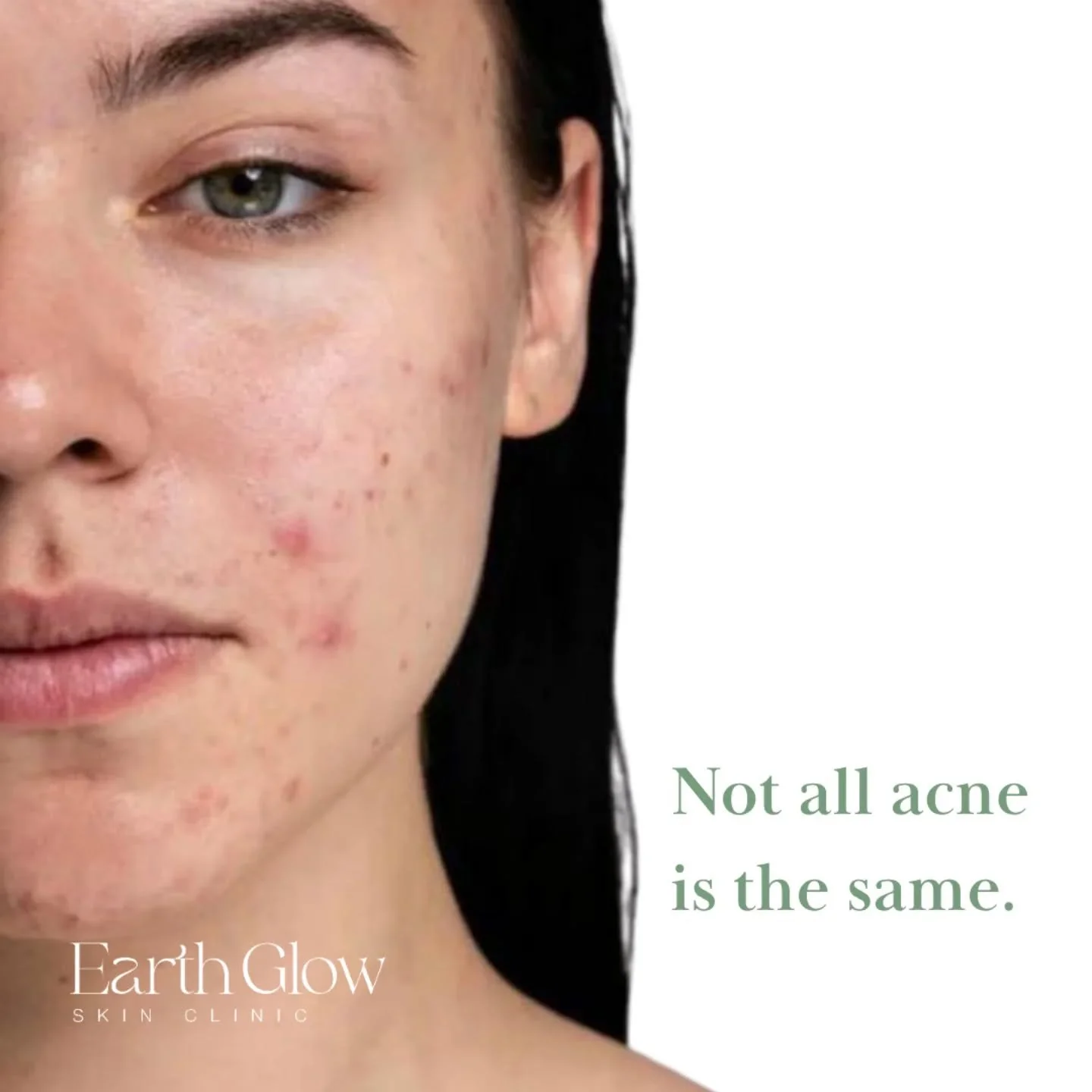 Not All Acne Is The Same.

Acne doesn't respond to the same approach, or products!

Let's not buy into the influencer who's saying this 'one product will heal your acne!' (they do it because they make money not because they truly care!)

That's where