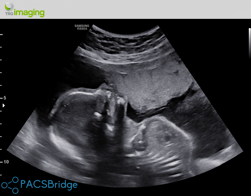 Cerclage