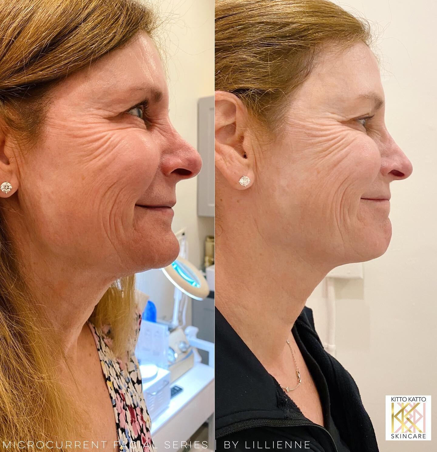 Before | After &gt;&gt; I did twelve sessions on my client with our MICROCURRENT facial (A non-invasive face lift.) 🤩✨ Notice how softened her neck line, and fine lines are around her eyes. Book a consultation/apt to ask about how you can get a natu
