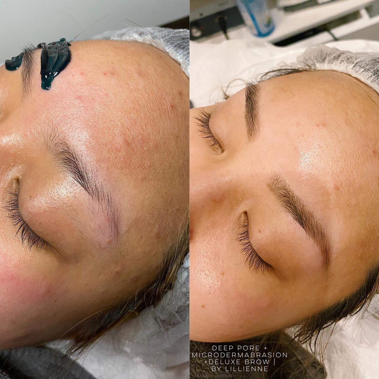 OK, Before I could wax my client&rsquo;s second brow I haaaaad to get a BEFORE photo (left). I did a Deep Pore Cleanse facial + Microdermabrasion with a Deluxe Brow Service. And I&rsquo;m just in awe at the AFTER photo. 😍😍😍✨🙌🏻 #winningskin #trus