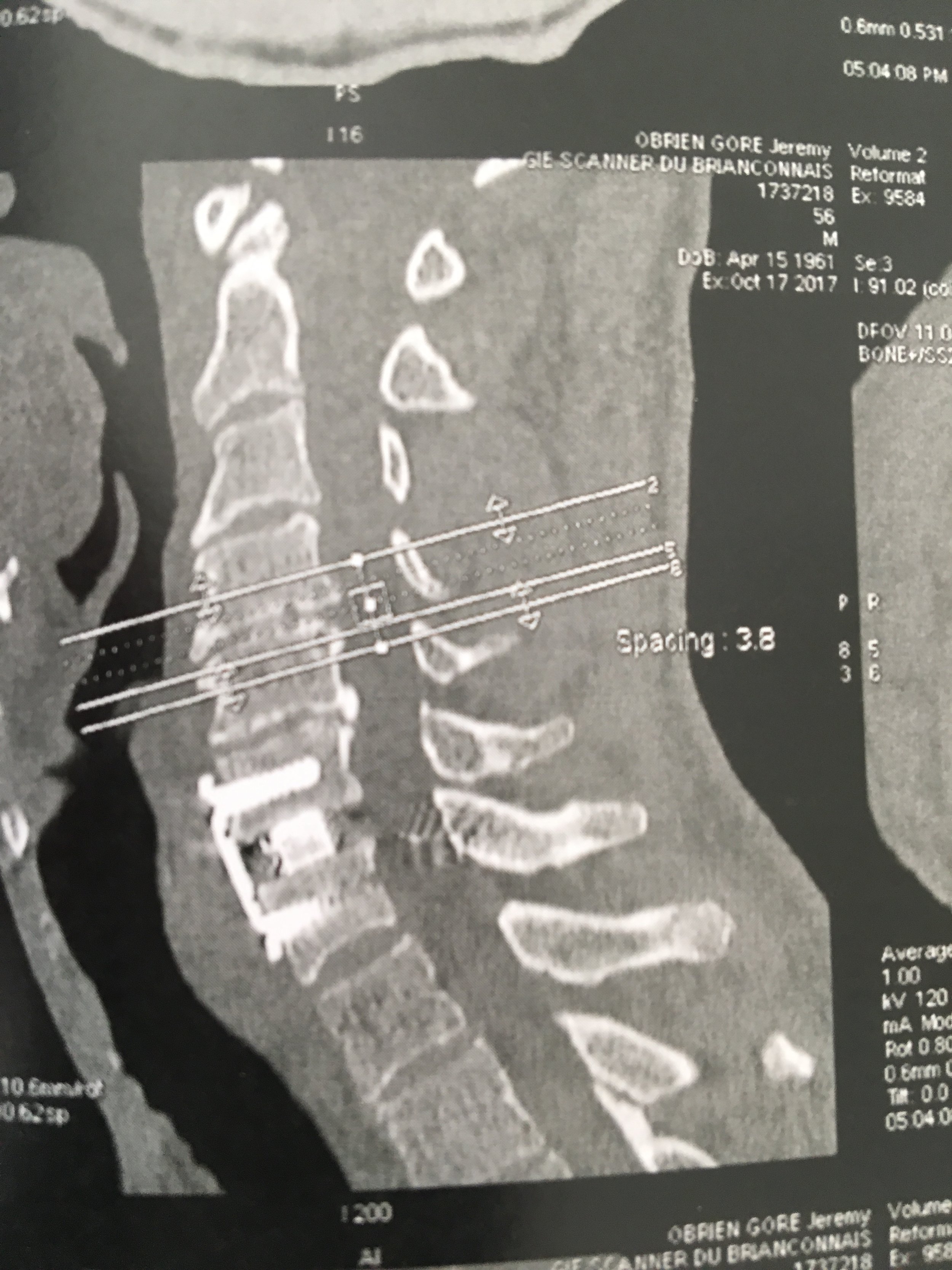 Neck X-Ray after Operation.JPG