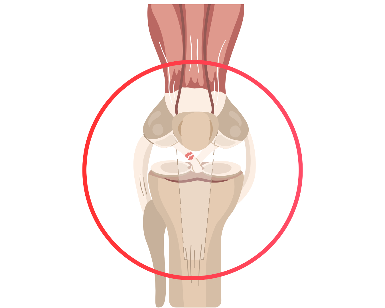 Anatomical illustration of an ACL tear