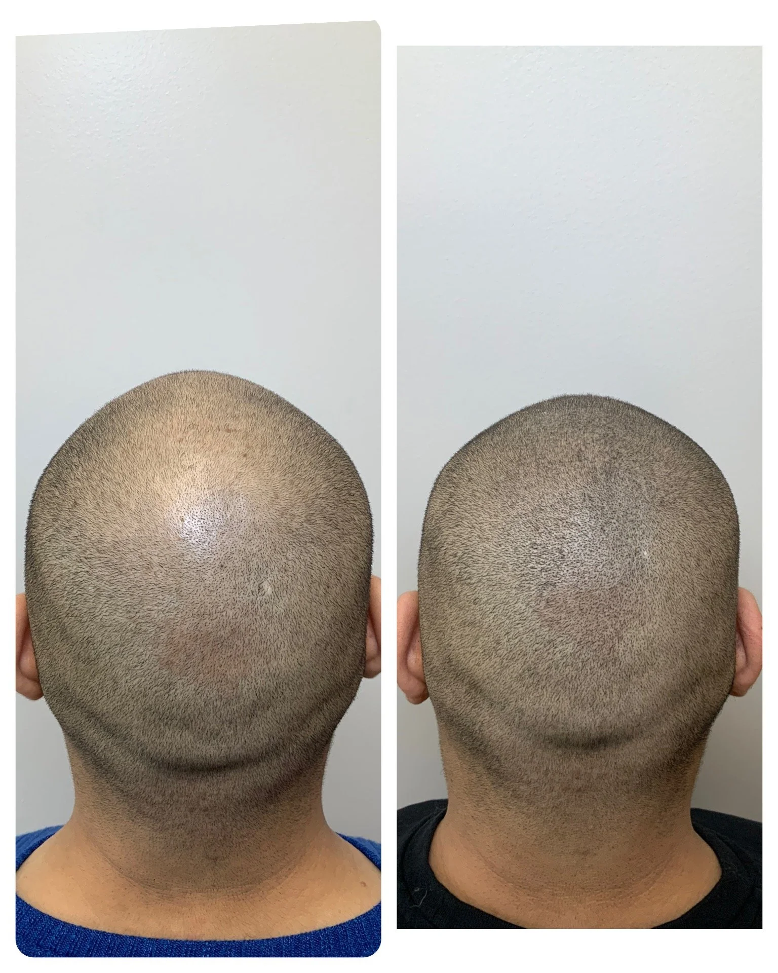 SMP OKC | SCALP MICROPIGMENTATION | ADD DENSITY | MALE BALDNESS | THINNING HAIR | PRIME LINE OKC 