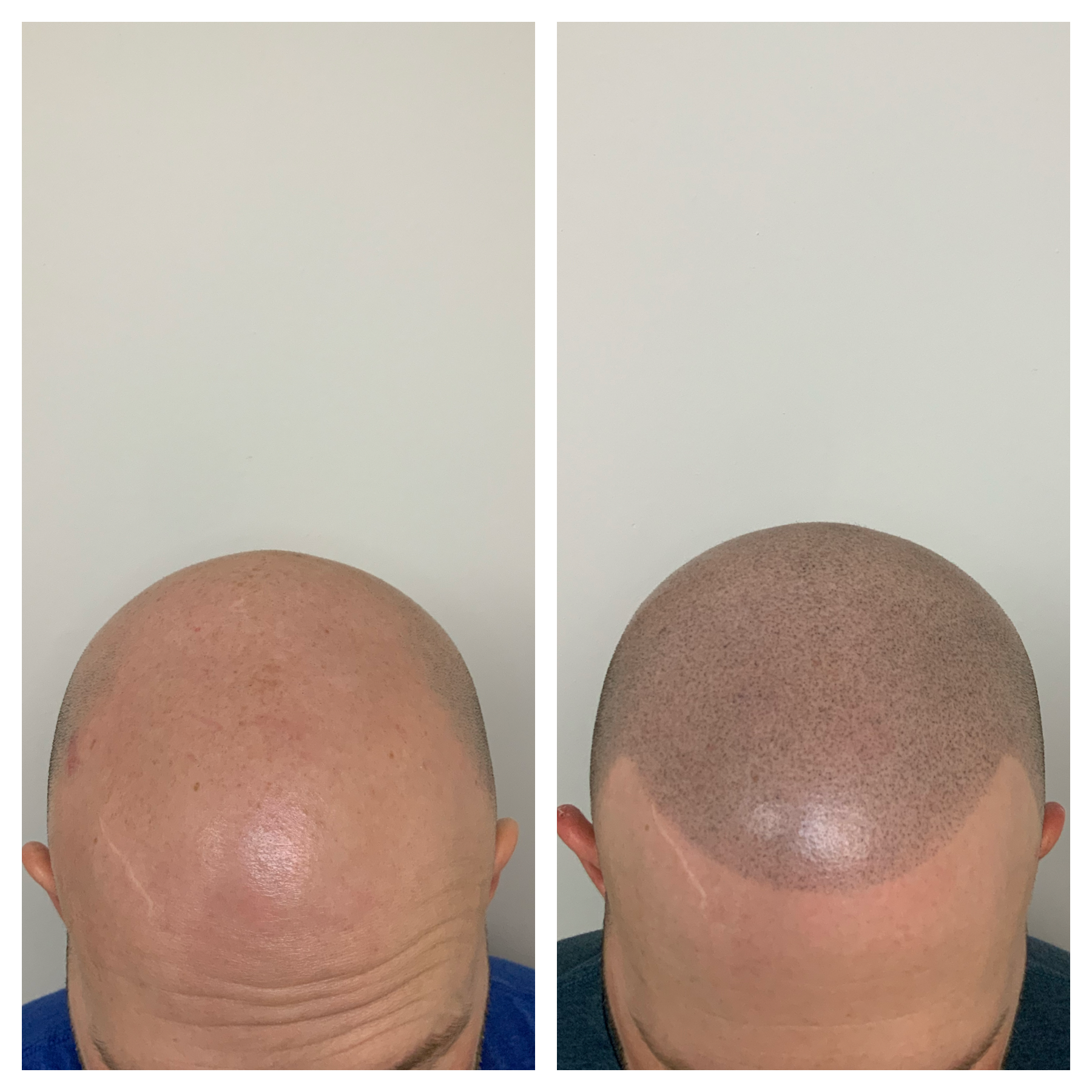 new hairline, hair restoration in oklahoma, hair restoration in kansas, hair restoration in texas, prime line okc